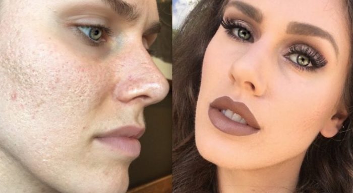 Makeup untuk Kulit Berjerawat Panduan Lengkap