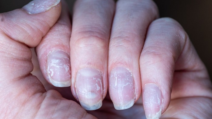 Skin peeling nails near care