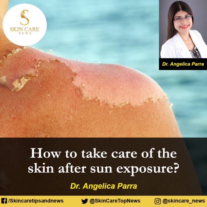 Cara Merawat Wajah Setelah Terkena Sinar Matahari